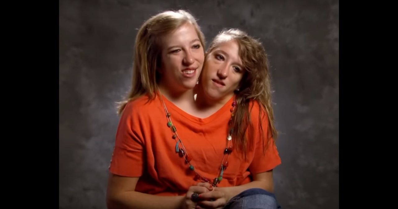  Hensel Twins